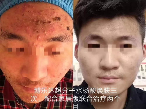 灰指甲的高发人群有哪些 灰指甲的高发人群有哪些