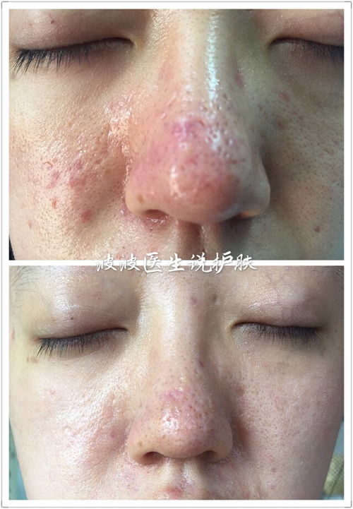 患了灰指甲会有哪些危害 患了灰指甲会有哪些危害