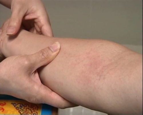 如何治疗脚气才永不会复发 如何治疗脚气才永不会复发