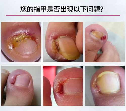 脚气出现的因素有哪些呢 脚气出现的因素有哪些呢