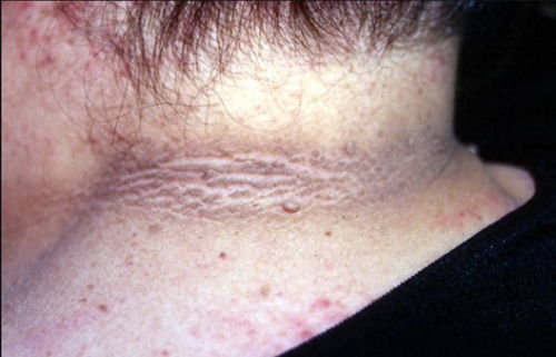 胆碱能性荨麻疹病人的饮食宜忌 胆碱能性荨麻疹病人的饮食宜忌