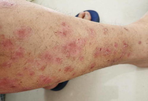 灰指甲的初期症状表现有哪些 灰指甲的五大征兆表现 灰指甲的初期症状表现有哪些 灰指甲的五大征兆表现