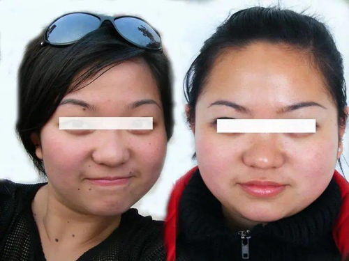 荨麻疹型皮肤的症状 荨麻疹型皮肤的症状