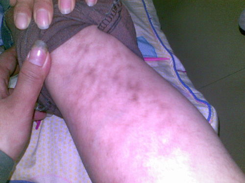 荨麻疹关节处频发原因 荨麻疹关节处频发原因