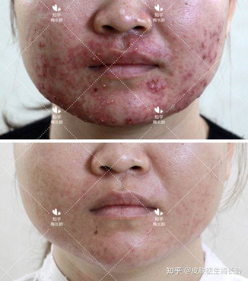 患了脚气会带来的影响有什么 患了脚气会带来的影响有什么