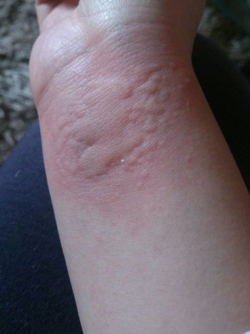 长痘痘不能喝牛奶吗 长痘痘不能喝牛奶吗