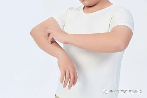 水泡型脚气用什么药好的快 水泡型脚气用什么药好的快