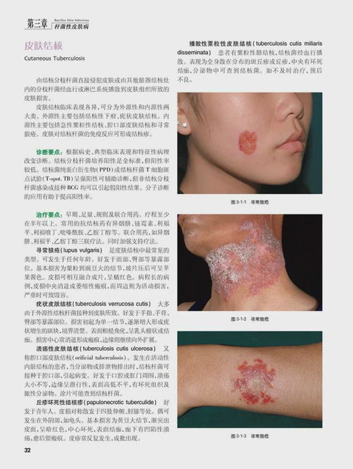鱼鳞病可以治愈吗 鱼鳞病可以治愈吗