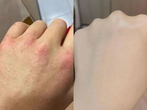 新生婴儿脸上有胎记怎么办 新生婴儿脸上有胎记怎么办