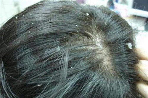 孕期脚气可采用一些偏方来进行治疗 孕期脚气可采用一些偏方来进行治疗