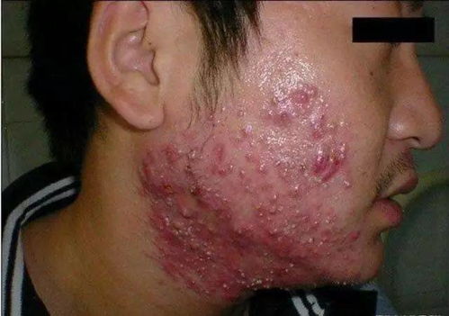 身上总是反复起荨麻疹怎么办 身上总是反复起荨麻疹怎么办