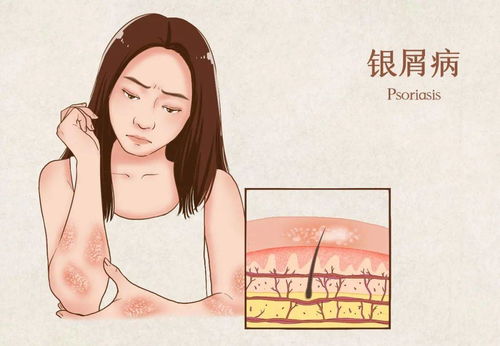 慢性荨麻疹治疗方法有哪些 慢性荨麻疹治疗方法有哪些