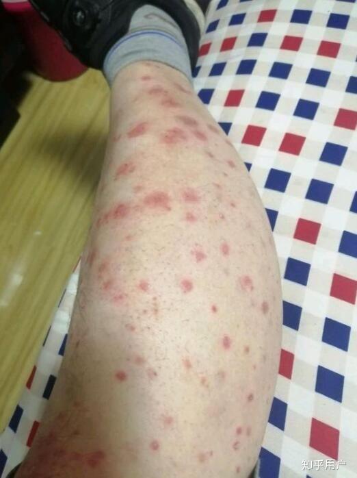 治疗婴儿湿疹做好哪些工作 治疗婴儿湿疹做好哪些工作