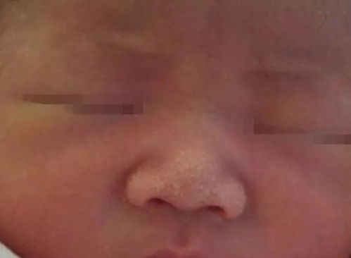 激光祛痣多久能恢复正常 激光祛痣多久能恢复正常