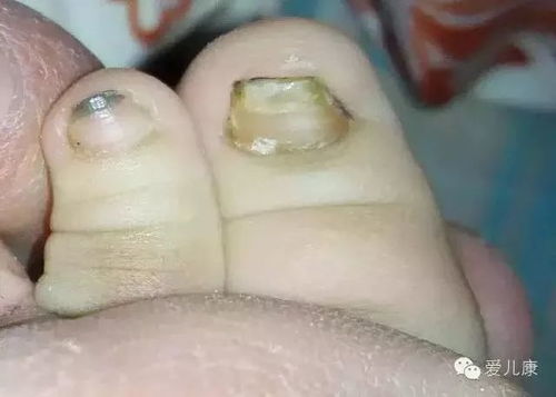 龟头发红但是不痛不痒 龟头发红但是不痛不痒