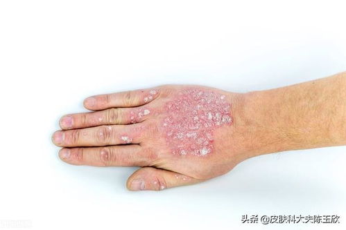 如何避免婴儿患上湿疹 如何避免婴儿患上湿疹