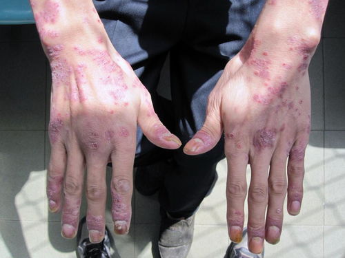 老人湿疹怎么办 老人湿疹怎么办