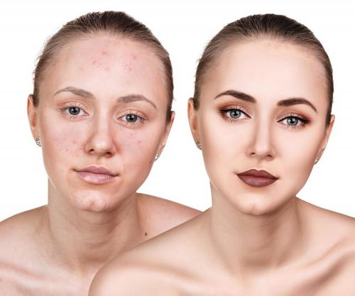 什么湿疹(湿疹是因为什么原因引起的) 什么湿疹(湿疹是因为什么原因引起的)