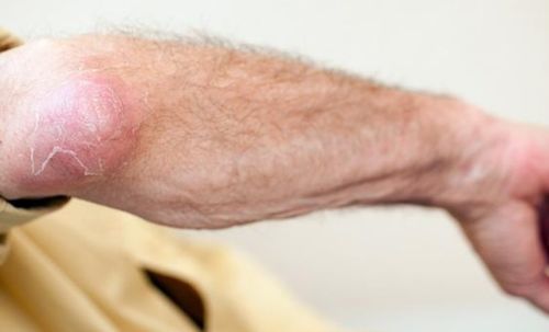 有灰指甲会带来哪些病痛 有灰指甲会带来哪些病痛