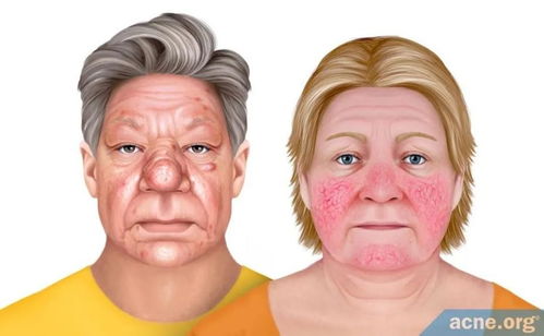 怀孕晚期可以吃菠萝吗 怀孕晚期可以吃菠萝吗