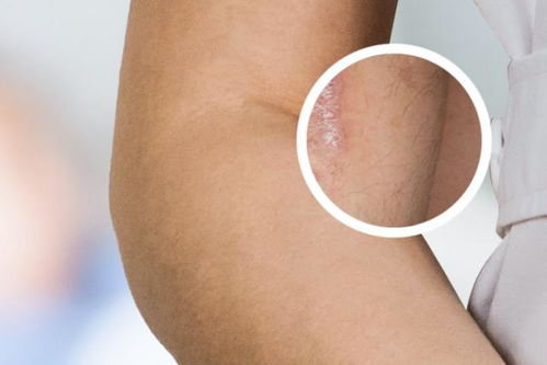 荨麻疹有哪些症状怎么治疗 荨麻疹有哪些症状怎么治疗