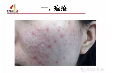 治灰指甲得偏方 治灰指甲得偏方