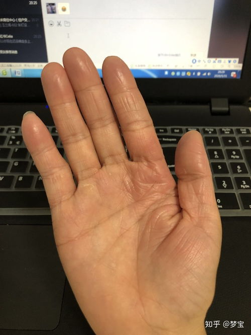 过敏性荨麻疹怎么办 过敏性荨麻疹怎么办