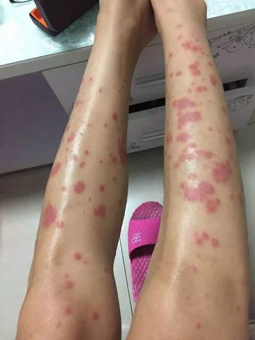 男性如何摆脱阴囊湿疹 男性如何摆脱阴囊湿疹