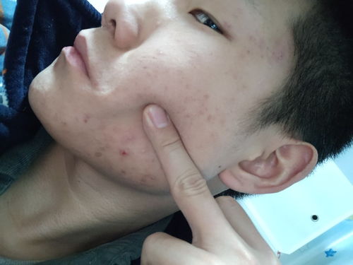 灰指甲患者吃什么有好处 灰指甲患者吃什么有好处