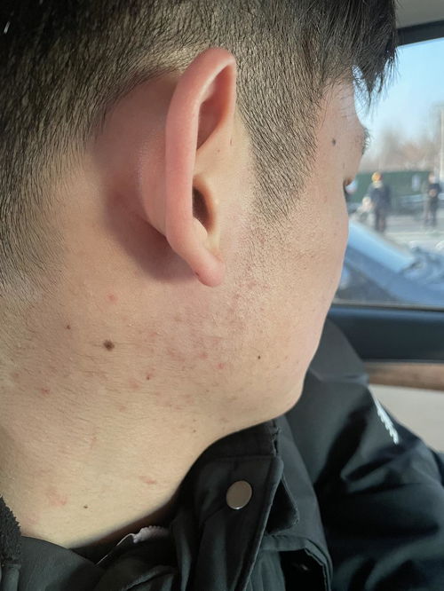 胎儿患溶血症会怎么样 胎儿患溶血症会怎么样