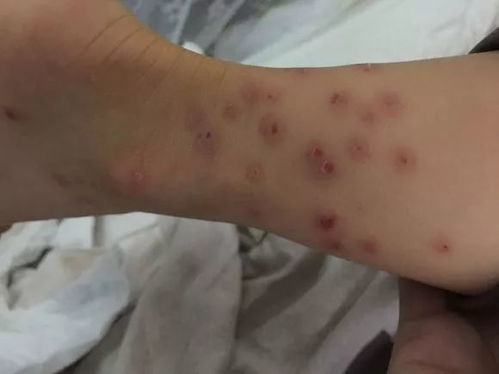 脚气喷剂名字 脚气喷剂名字