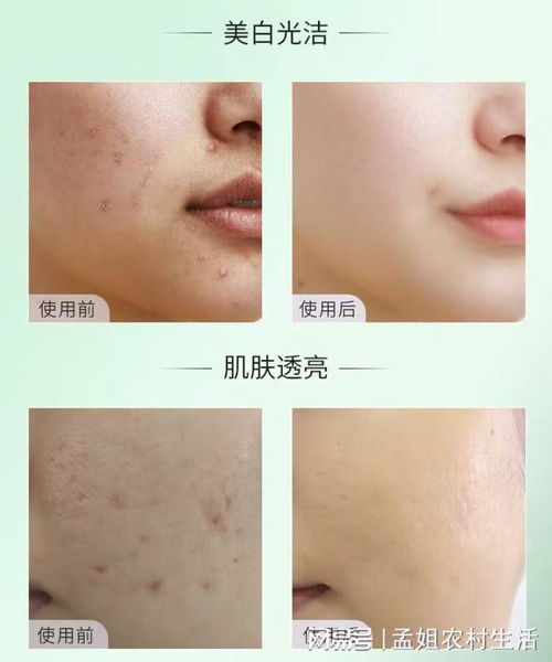 新生宝宝湿疹父母细节 新生宝宝湿疹父母细节