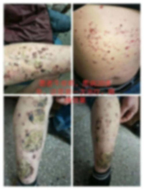 夏季木瓜当药吃 治疗脚气效果好 夏季木瓜当药吃 治疗脚气效果好