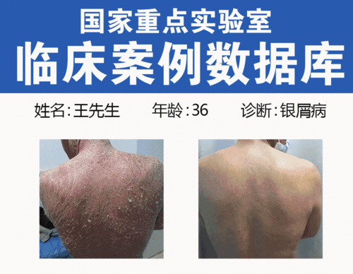 脓疮性痤疮怎么治疗 脓疮性痤疮怎么治疗