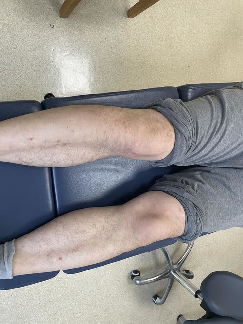 女性荨麻疹该注意哪些呢 女性荨麻疹该注意哪些呢