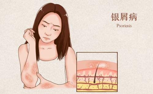 疱疹抹什么药膏 疱疹抹什么药膏