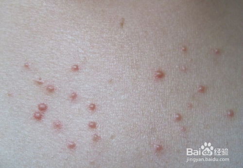 糖尿病合并甲亢如何治疗 糖尿病合并甲亢如何治疗