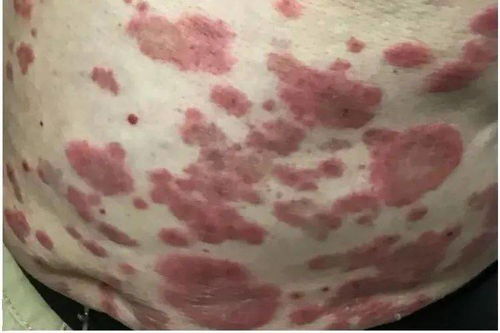 灰指甲的常见症状有什么 灰指甲的常见症状有什么