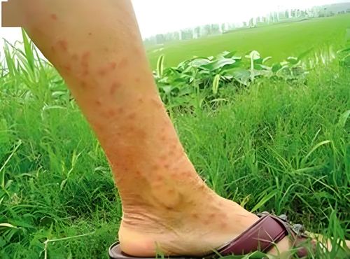 患有灰指甲该怎么护理呢 患有灰指甲该怎么护理呢