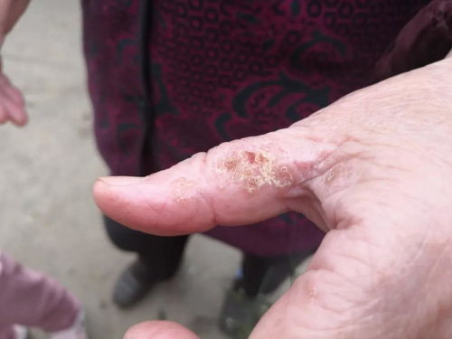 怎样祛除灰指甲比较好 怎样祛除灰指甲比较好