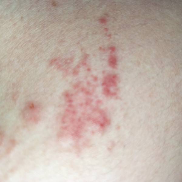 荨麻疹反复犯怎么办 荨麻疹反复犯怎么办