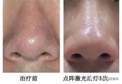 得了湿疹危害有什么 得了湿疹危害有什么