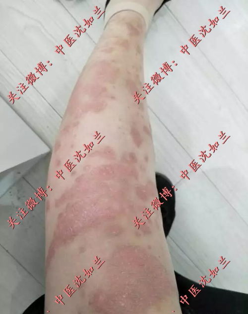 脓疱型牛皮癣是怎么引起的 脓疱型牛皮癣是怎么引起的