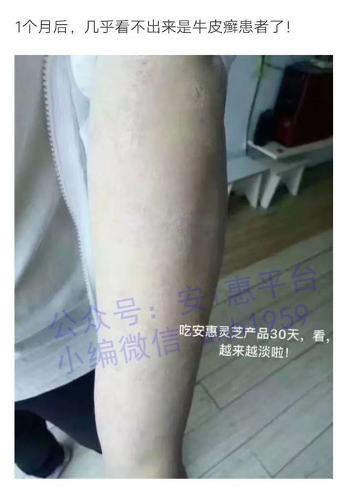 背部牛皮癣怎么护理 背部牛皮癣怎么护理