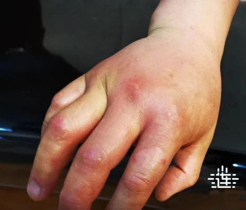 牛皮癣属于自身免疫疾病吗 牛皮癣属于自身免疫疾病吗