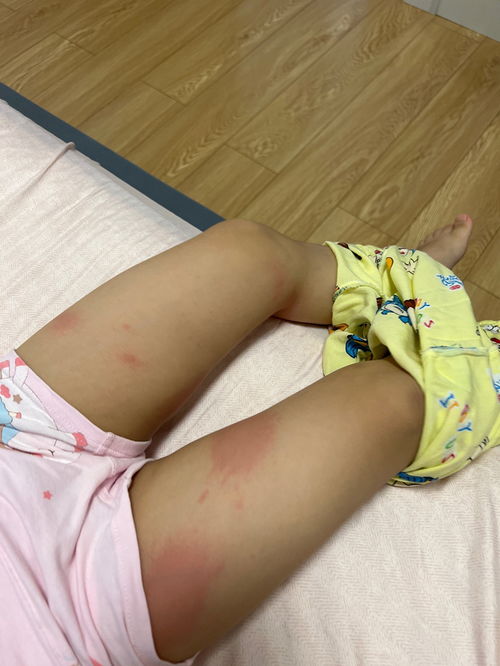 寻常型银屑病治愈大概要多长时间 寻常型银屑病治愈大概要多长时间