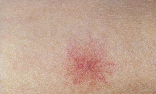 灰指甲患者适合穿什么样的鞋呢 灰指甲患者适合穿什么样的鞋呢