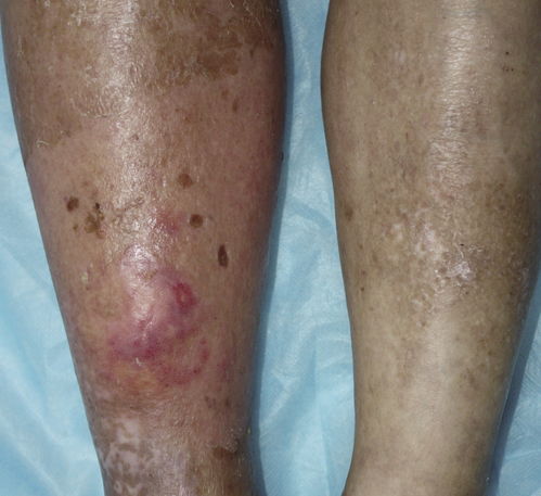 6种食物容易吃出荨麻疹日常不能吃哪些食物 6种食物容易吃出荨麻疹日常不能吃哪些食物