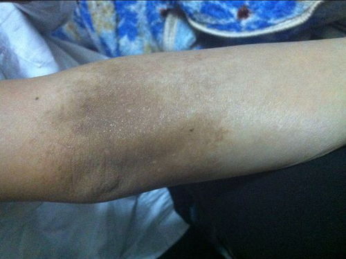 灰指甲的特征 灰指甲的日常保健方法 灰指甲的特征 灰指甲的日常保健方法