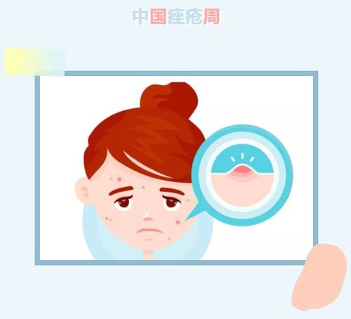 樟木子的药用价值 樟木子治疗脚气的秘方 樟木子的药用价值 樟木子治疗脚气的秘方